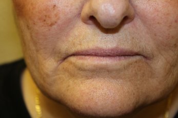 Vampire Facelift 2 - After Treatment